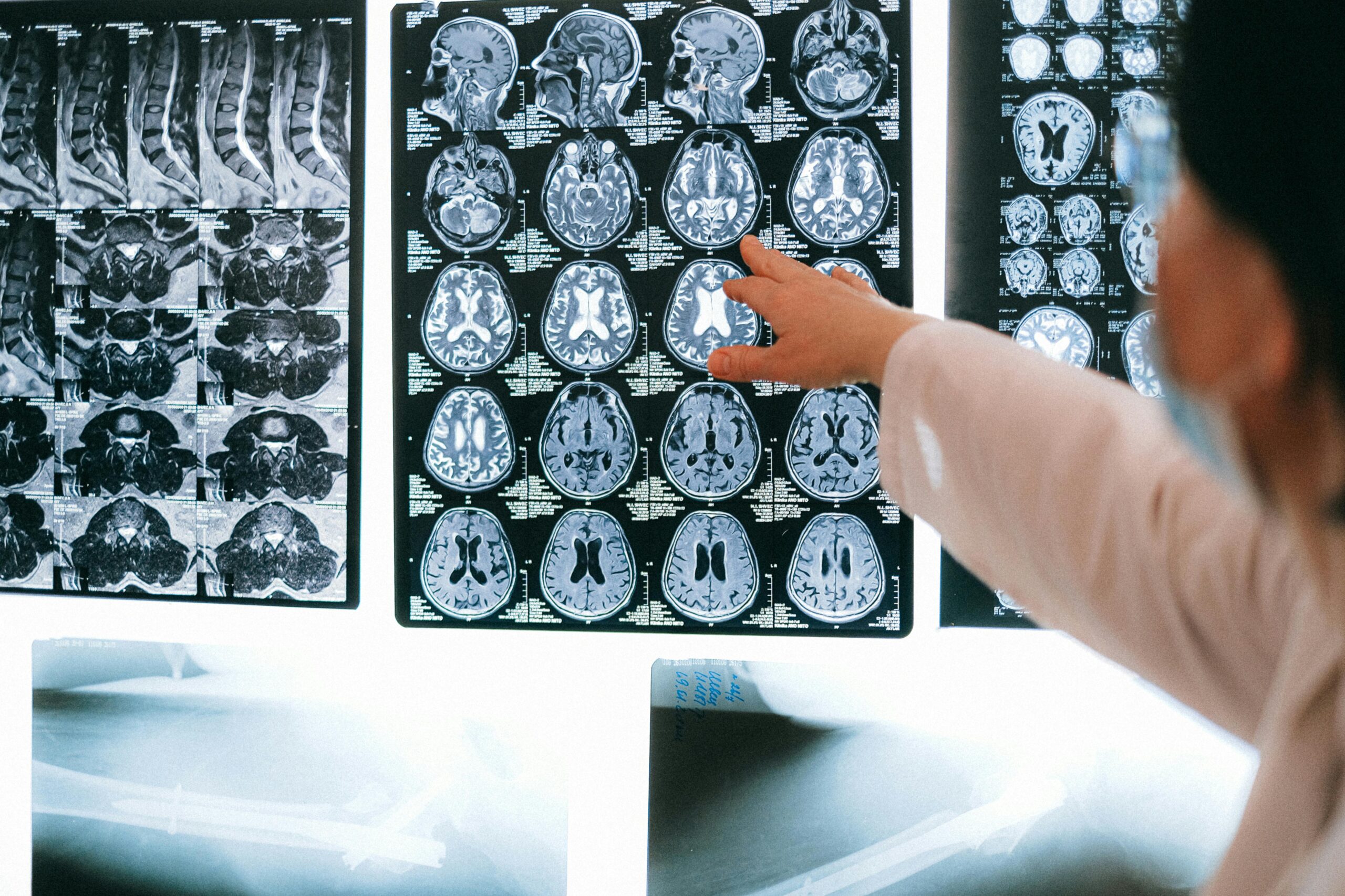 Brain Aneurysm vs Stroke: Don’t Between Confuse the Two